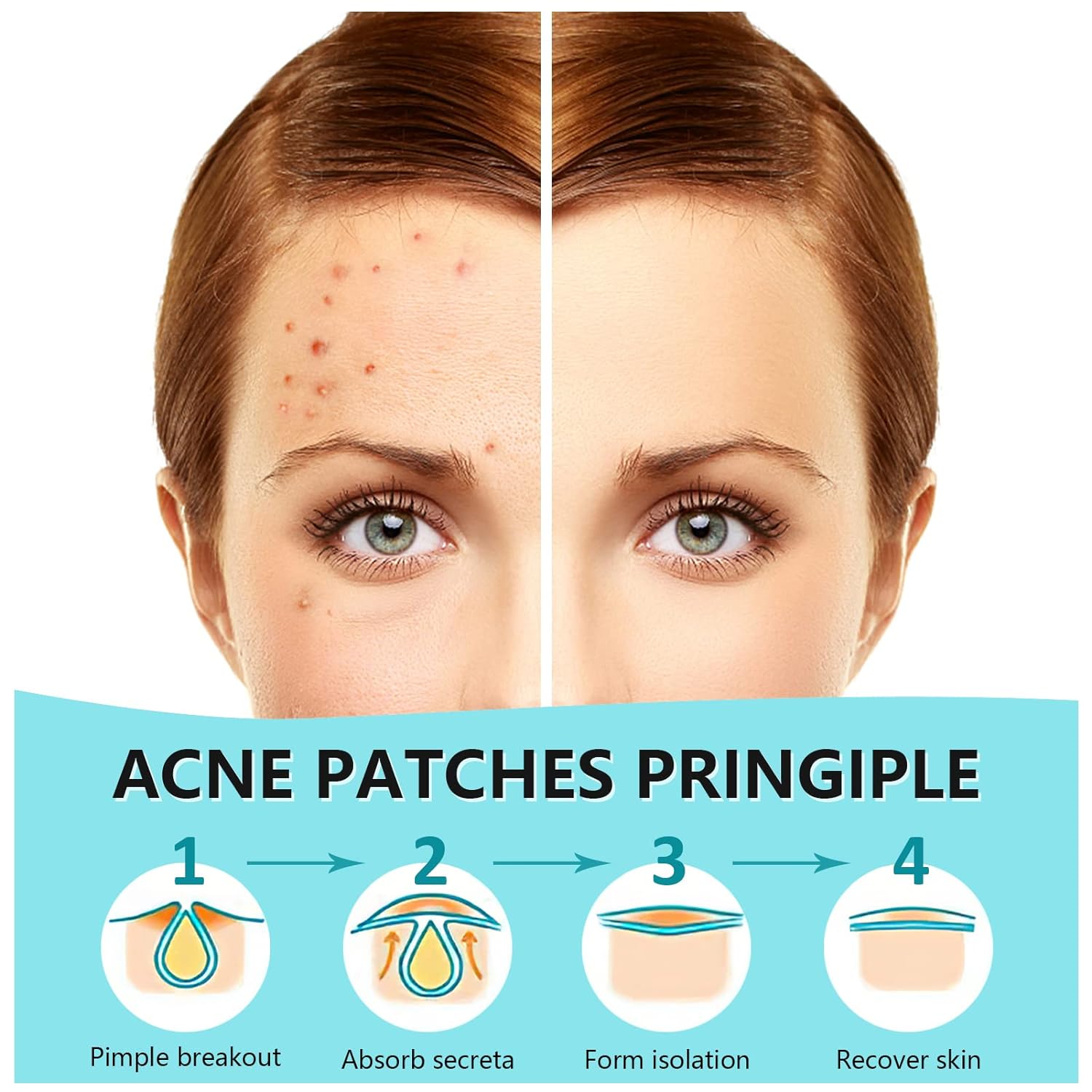 Pimple Patches for Face 180 Counts Hydrocolloid Acne Patches for face Invisible Zit Patches for Face Acne Spot Treatment Patch Blemish Patches Cover Patches Stickers