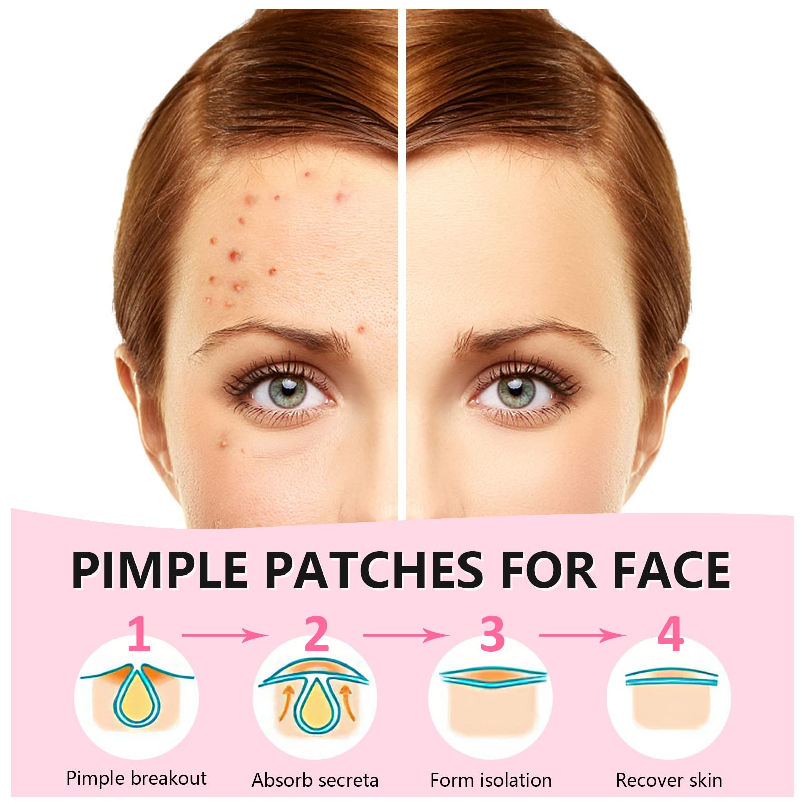 Star Pimple Patch 108 Counts, Pimple Patches for Face Pimple Patches Stars Hydrocolloid Acne Patches Zit Patches for Face Cystic Acne Treatment Blemish Spot Treatment for All Skin Type